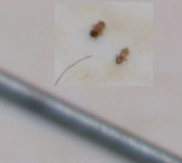 Very Tiny Bugs In Bedroom | Psoriasisguru.com