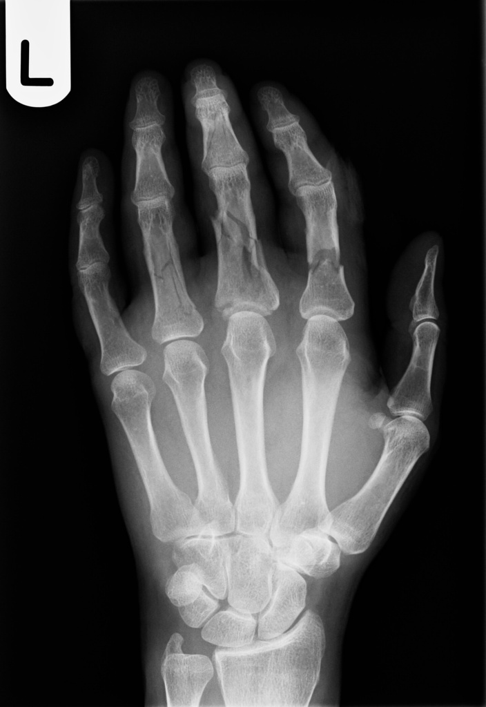 php Fracture detection in hand using image proccessing Stack Overflow