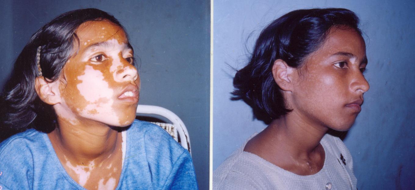 human biology Is the Michael Jackson skin pigmentation disease