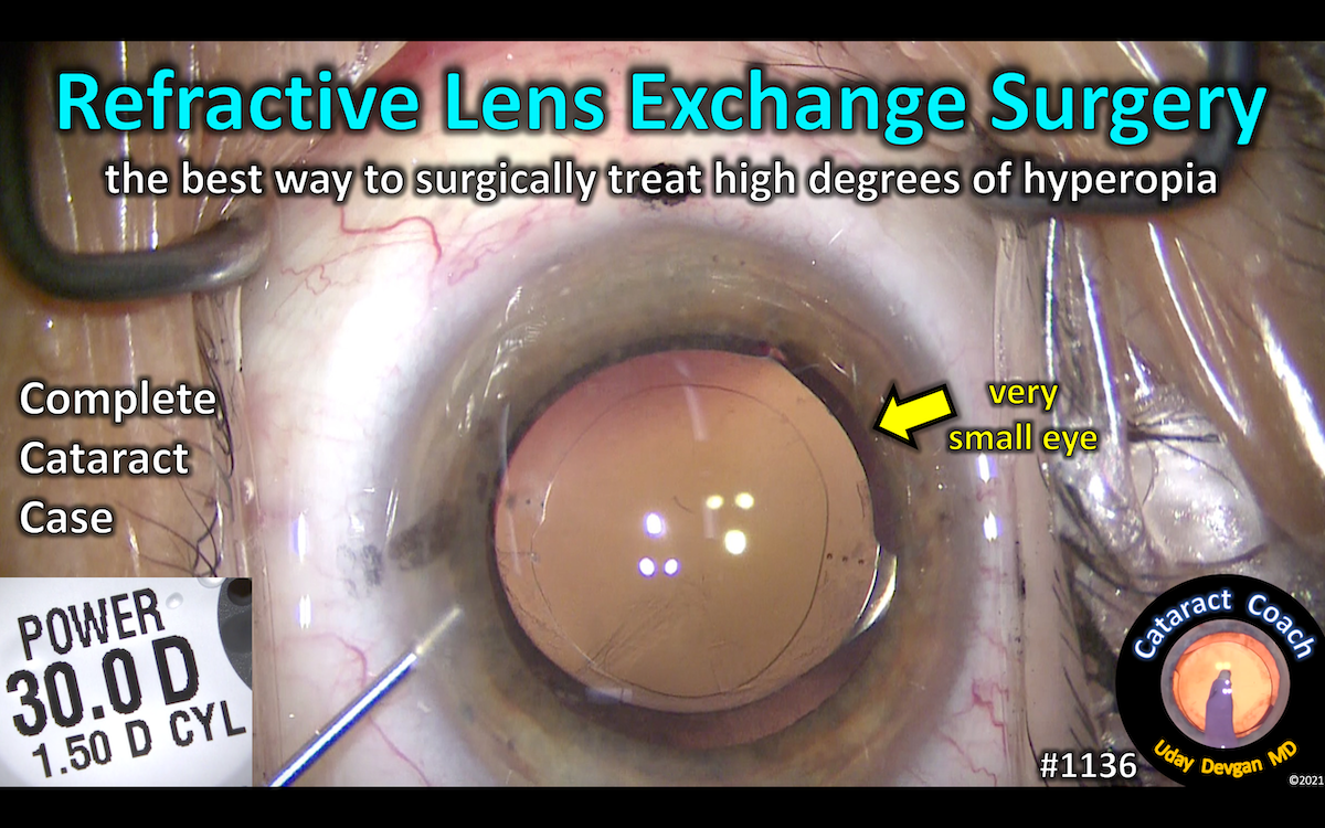1136: Refractive Lens Exchange Surgery – Cataract Coach™