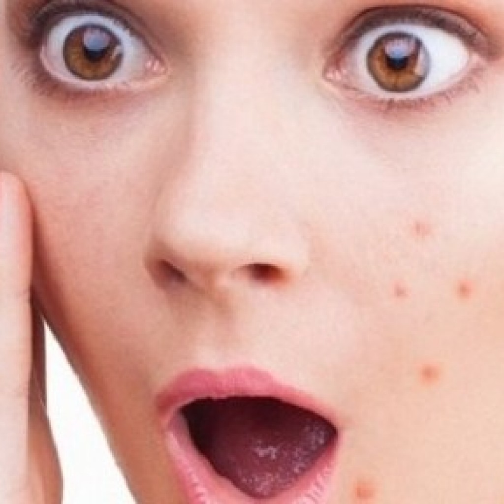 9 Cara Menghilangkan Bekas Jerawat yang Hitam Secara Alami