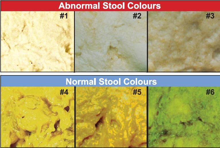  infant stool colour chart best picture of chart anyimageorg