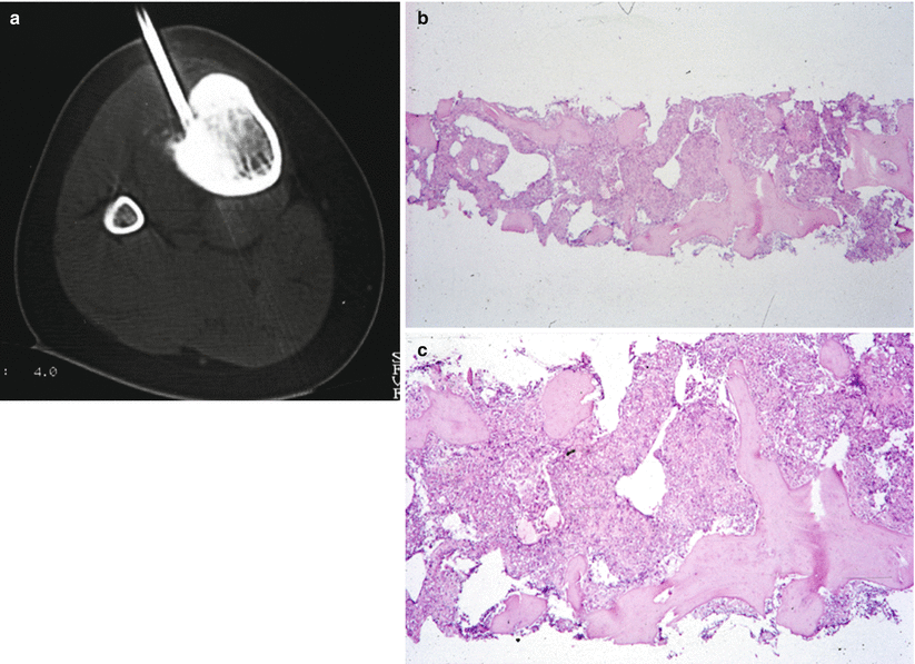 Bone Tumors: A Practical Guide to Imaging Radiology
