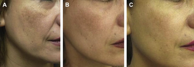 Aesthetics and Cosmetic Surgery for Darker Skin.
