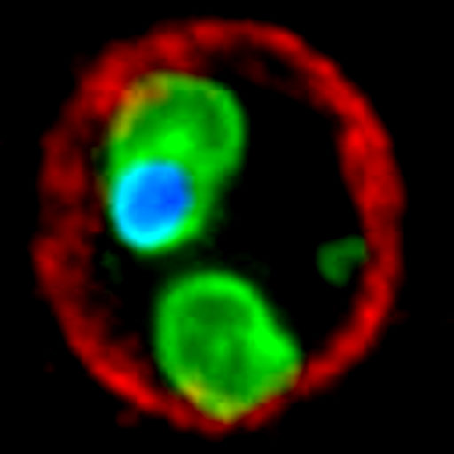Severe Malaria Malaria Site