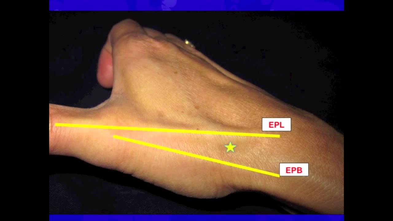 Thumb CarpalMetacarpal (CMC) Joint injection YouTube