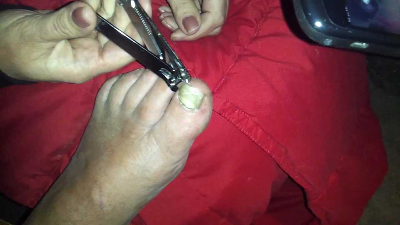 Toenail being ripped off by clamps YouTube