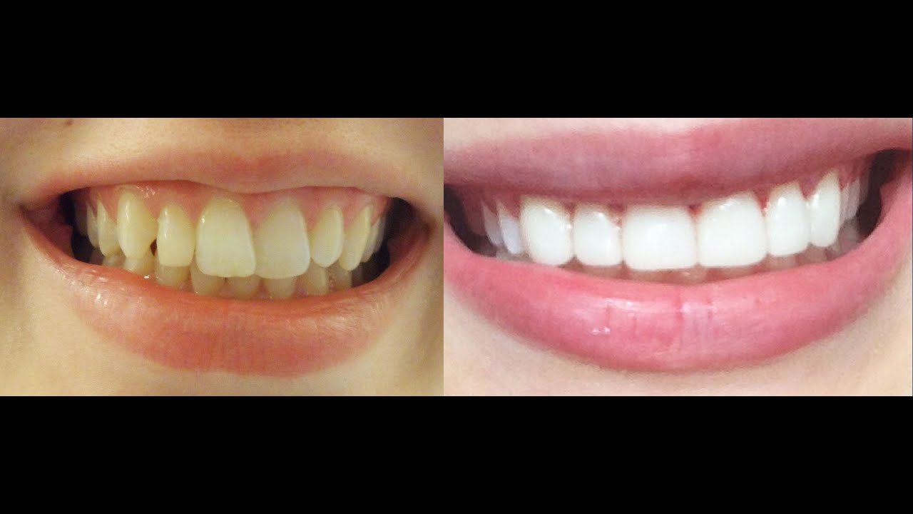 How to get INSTANT STRAIGHT teeth without braces, Veneers & whitening