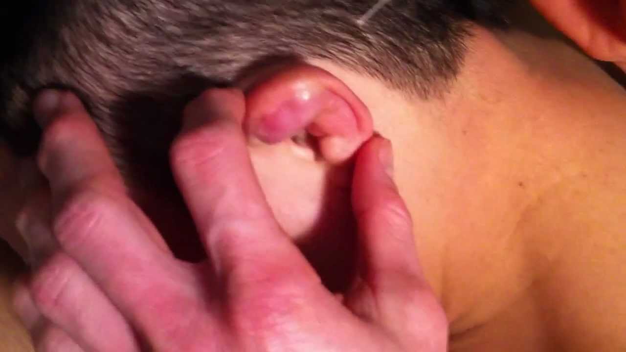 Massive Cauliflower Ear Drain YouTube