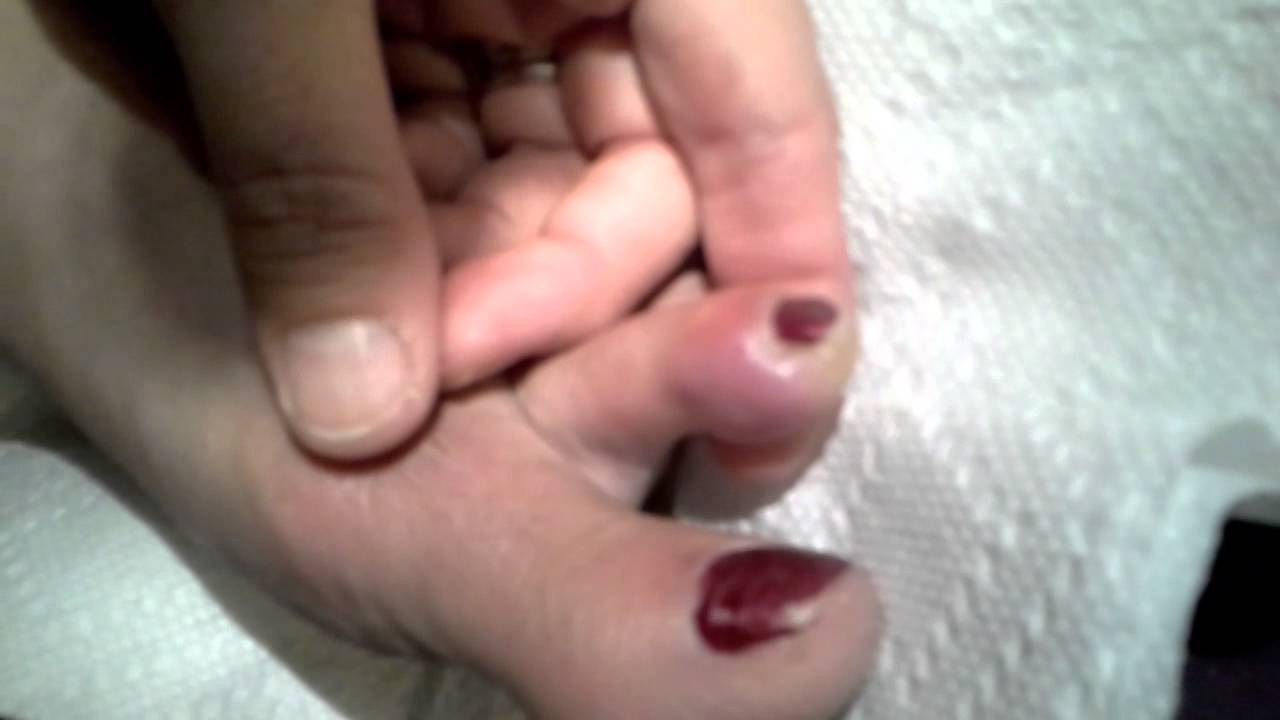 Careful when getting pedicure! Infected Toe YouTube