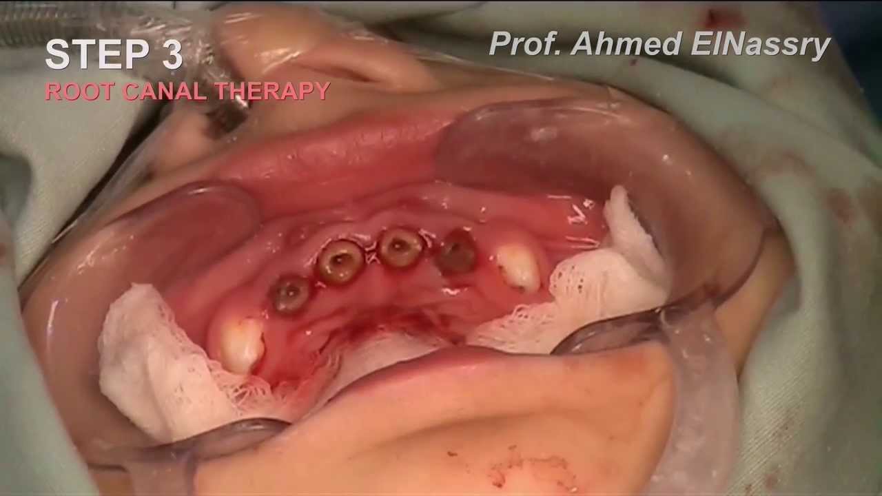 2 years; Severe Early ChildHood Caries; Complete Dental Treatment YouTube
