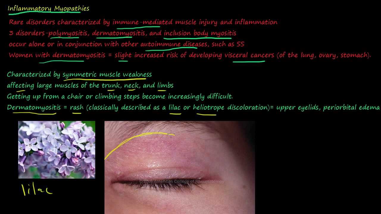103P Polymyositis, Dermatomyositis, Inclusion body myositis, Mixed