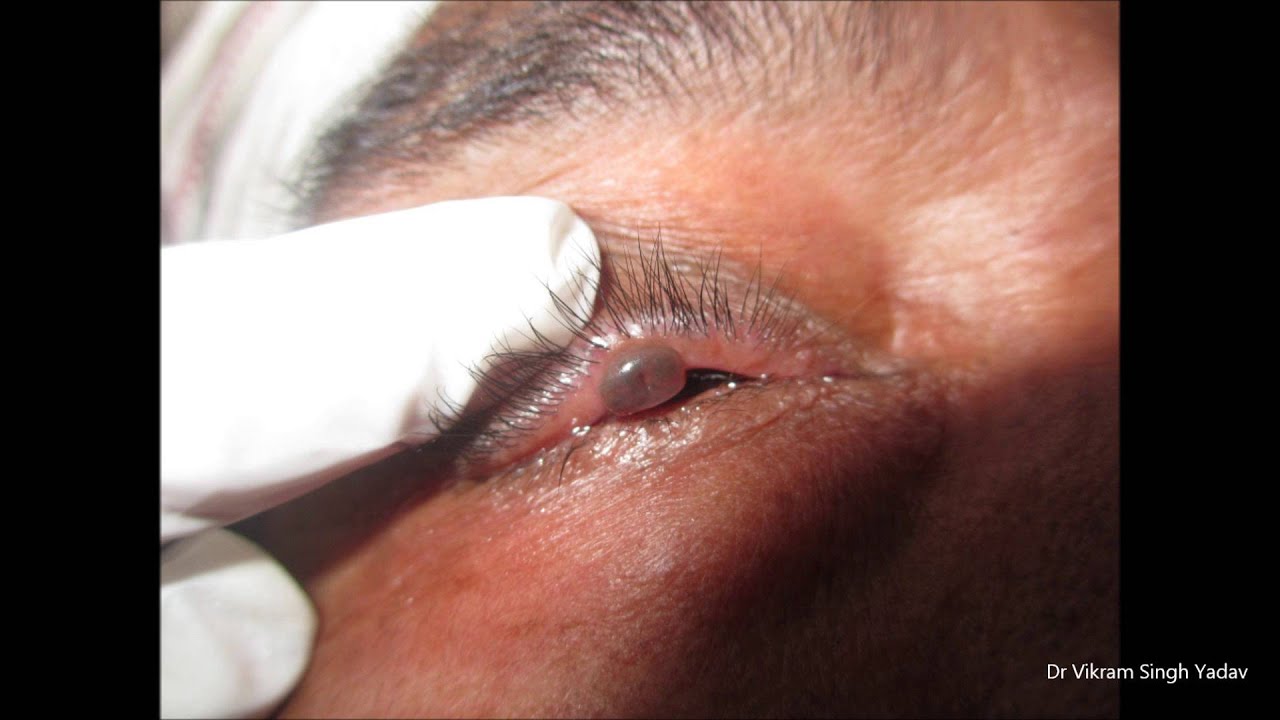 Growth On Eyelids YouTube