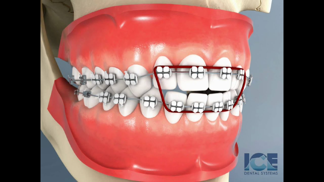 Anterior Openbite Braces YouTube