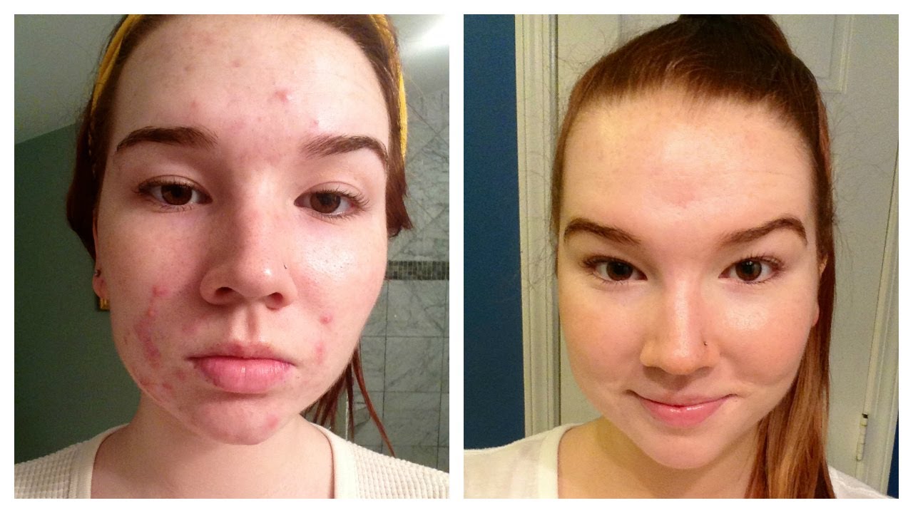Roaccutane Avis ‒ Mon traitement Roaccutane