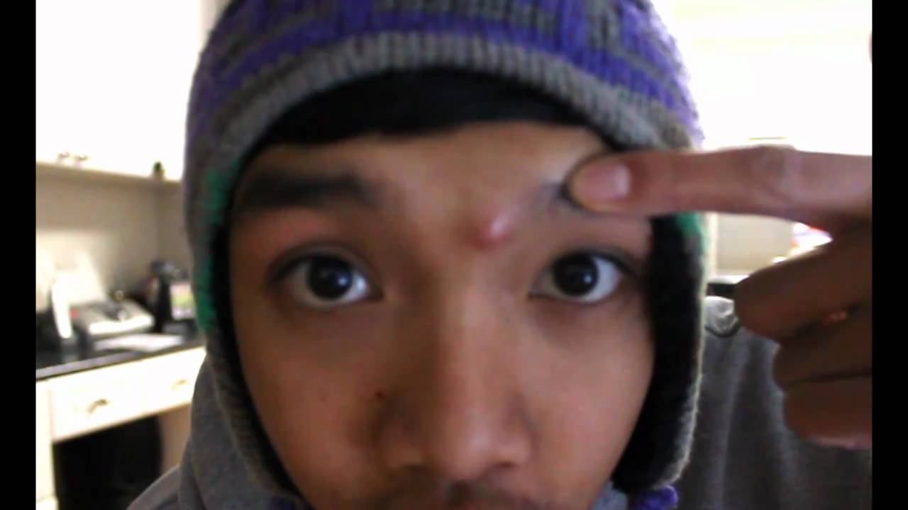 HUGE ZIT on forehead YouTube