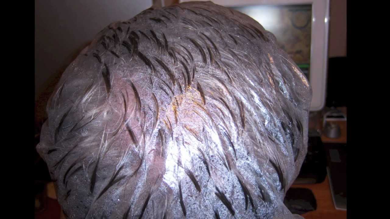 How To Get Rid Of Lash Lice By seeing a dermatologist