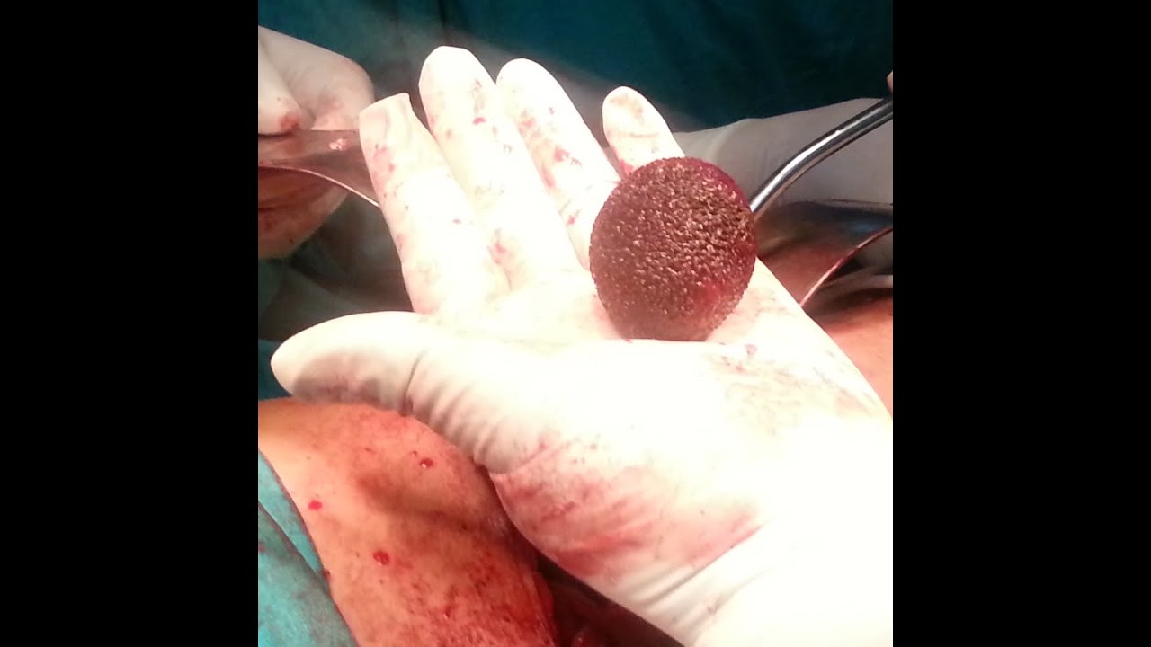 Big Kidney Stone, size of big hen egg Open Pyelolithotomy Dr