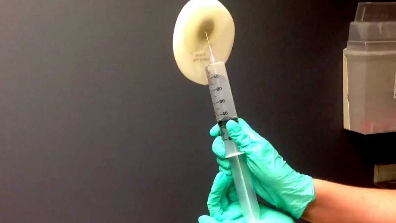 Breast Reconstruction Expanders and the Fill Process YouTube