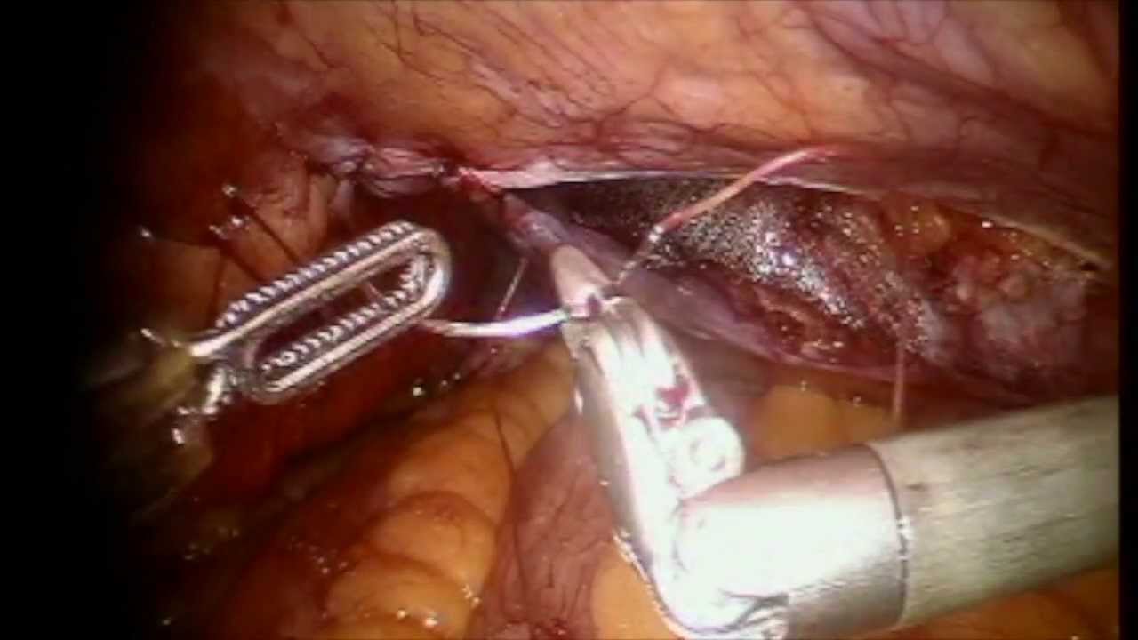 Robotic Inguinal Hernia Repair (TAPP) YouTube