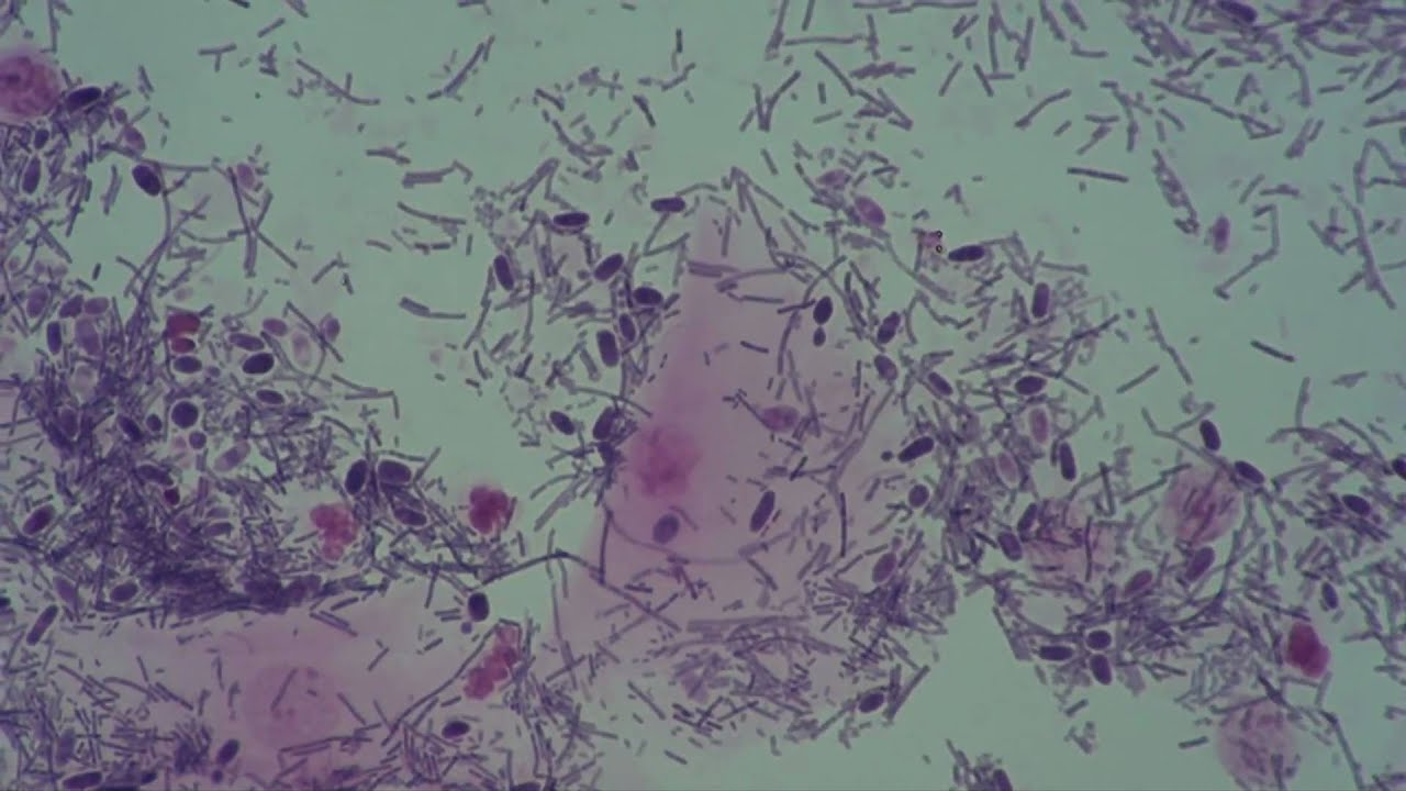 Gynaecology. Bacterial vaginosis. Candidiasis. Candida albicans. YouTube