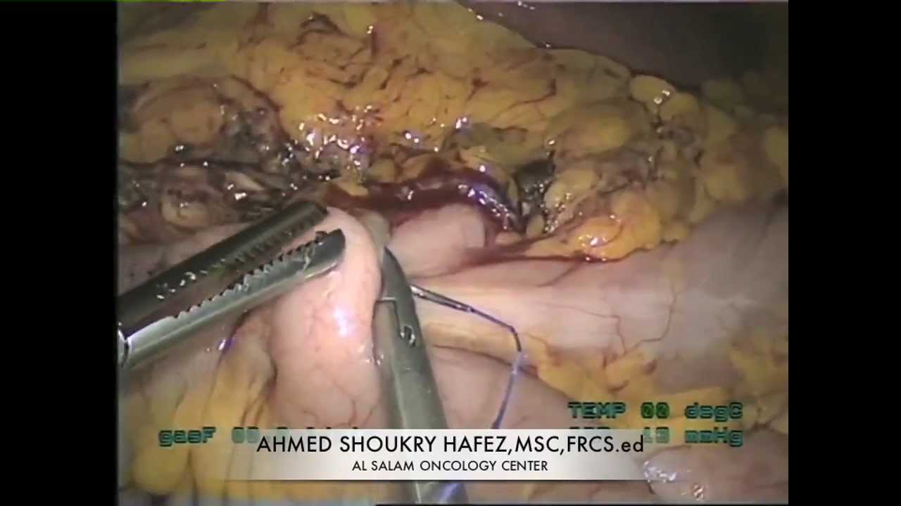 right hemicolectomy step by step دكتور احمد شكري حافظ