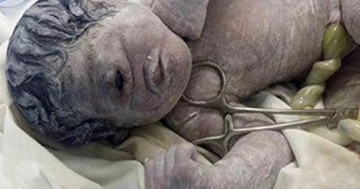 Heartbreaking image released of baby born with 'cyclops' eye and no