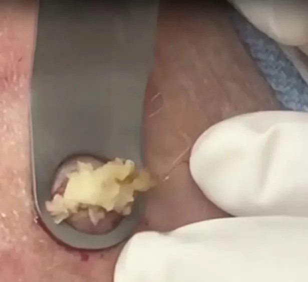 Dr Pimple Popper squeezes 'mother' of all cysts which explodes with pus
