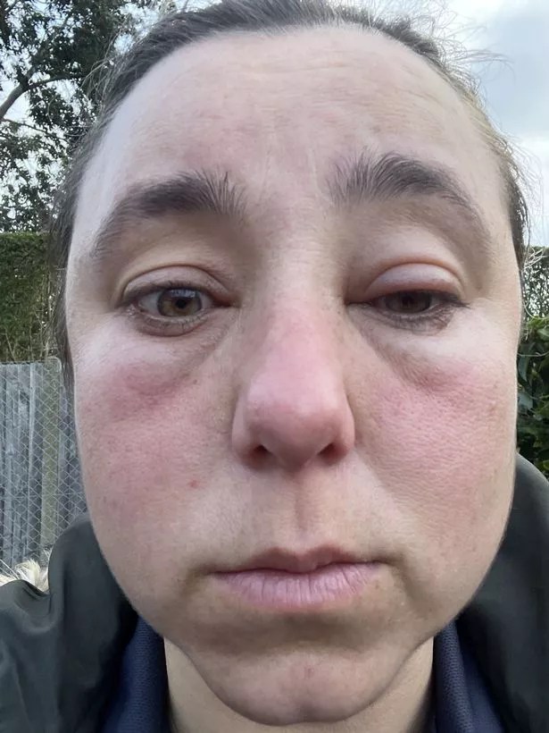 Mum who was left looking 'like the Elephant Man' after Covid vaccine