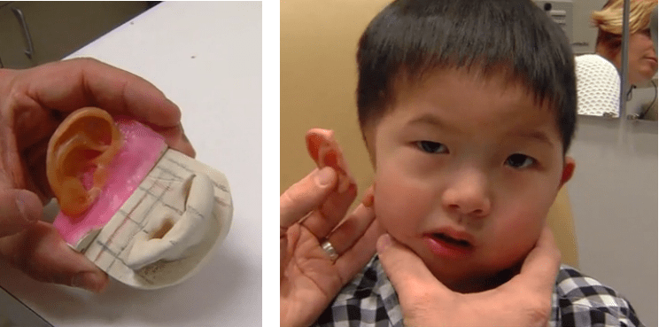 4YearOld Boy Gets a New Prosthetic Ear Thanks to 3D Printing The Voice of 3D