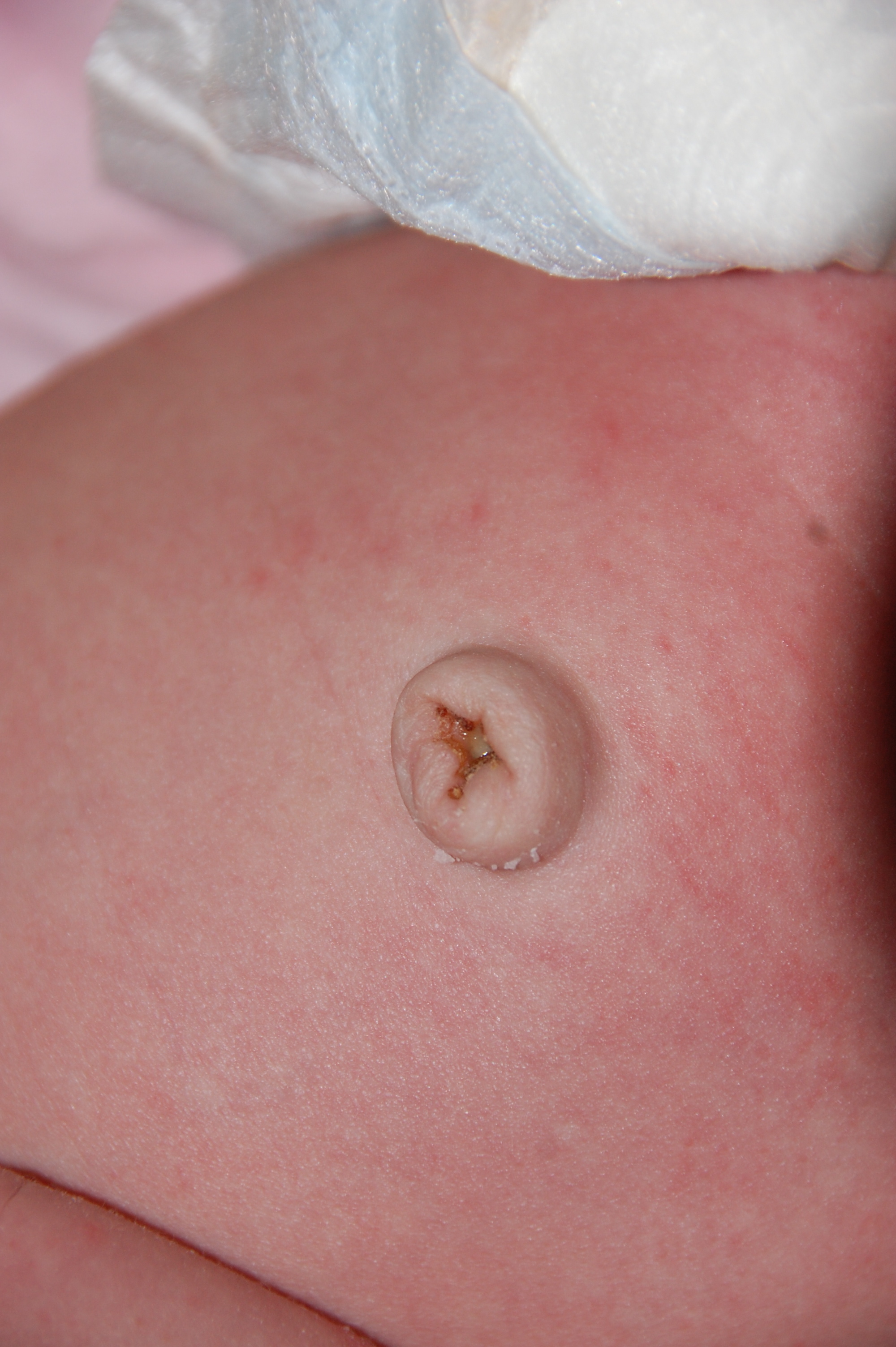 Infant Umbilical Hernia