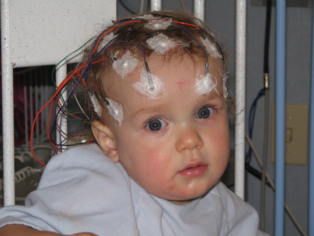 Epilepsy and Our Journey to a Diagnosis