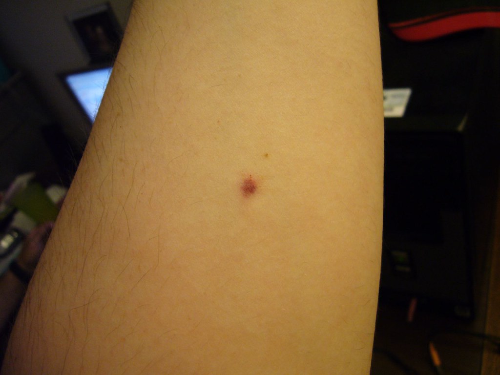 Mono Blood Test BRIGHT RED PERIOD BLOOD
