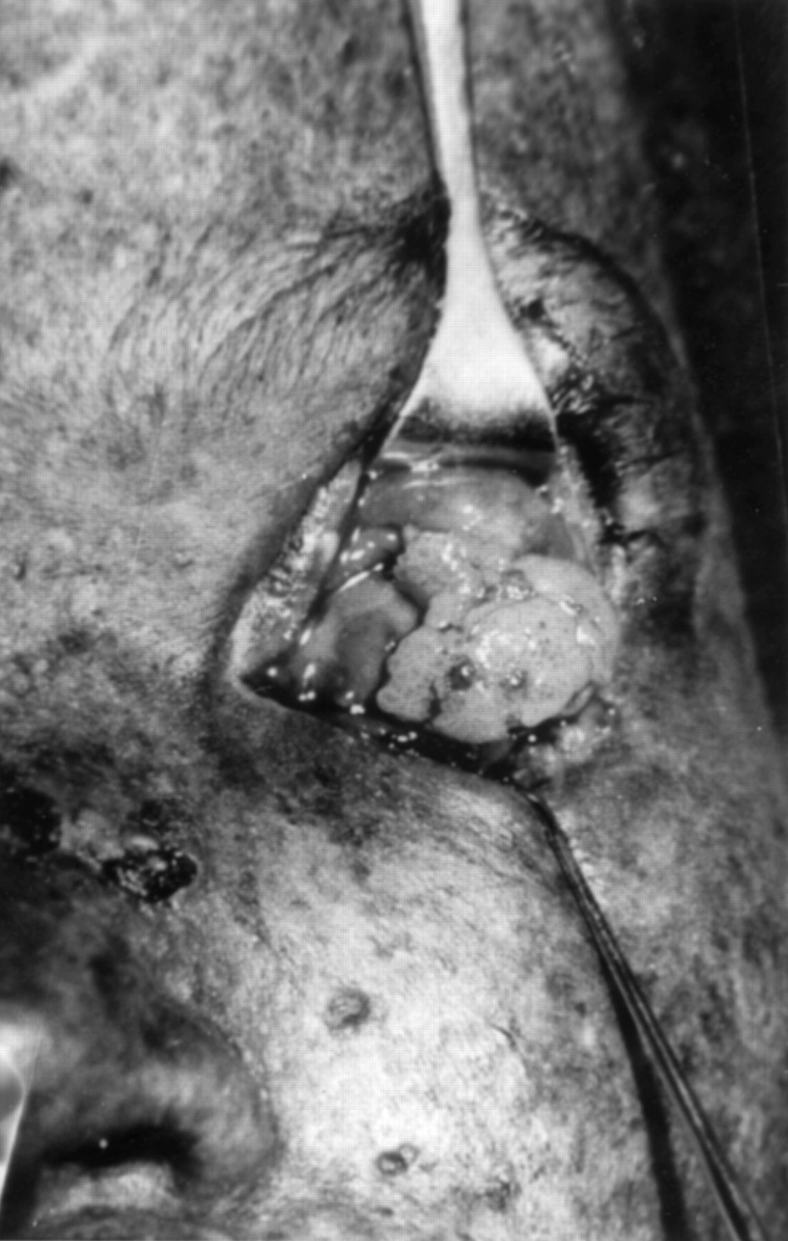 Xeroderma pigmentosum in three consecutive siblings of a Nigerian family observations on