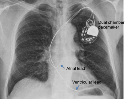 Dual chamber pacemaker Chest Xray Cardiophile MD