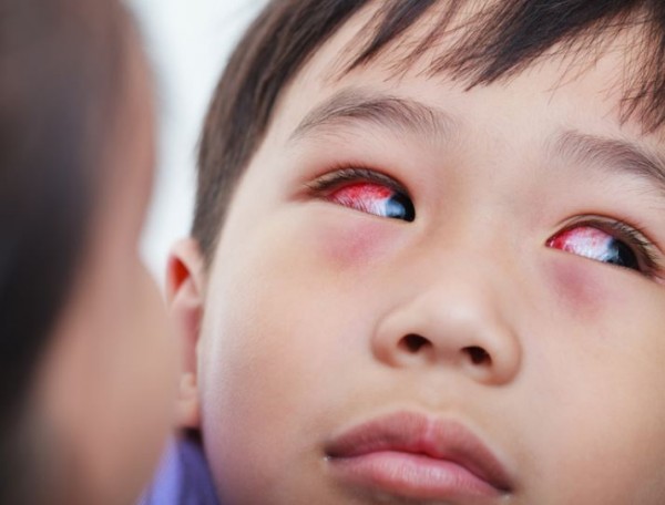 Sticky, sore, red and watery... Treating your child’s...