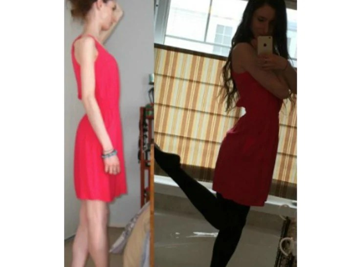 The 23yo who posted her anorexia recovery photos online.