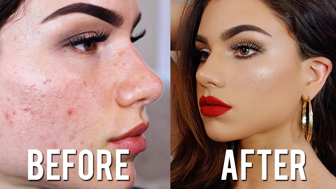 How To Cover Acne With Makeup Without Looking Cakey Cure