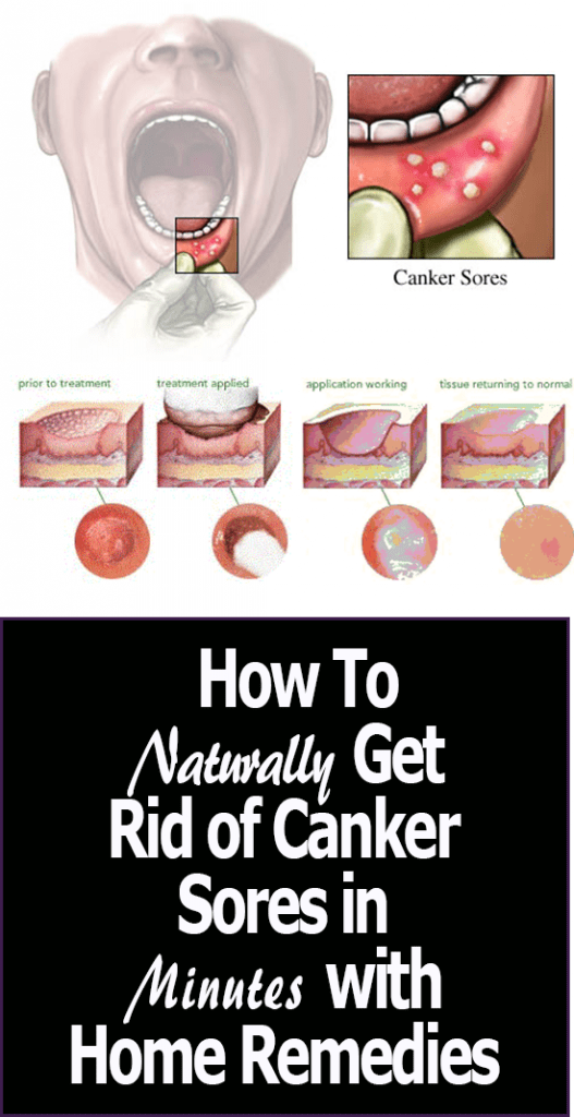 Home Remedies for Canker Sores