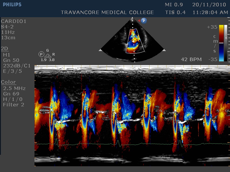 Color M mode in 2 1 AV Block