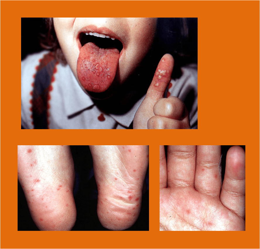 What happens when an eczema baby get HFMD Eczema Blues