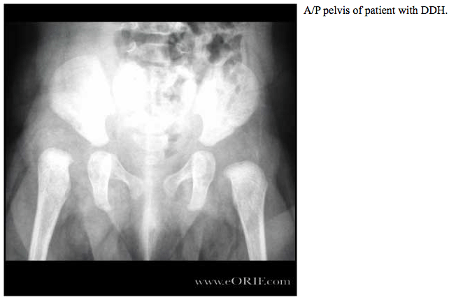 Developmental Dysplasia of the Hip eORIF