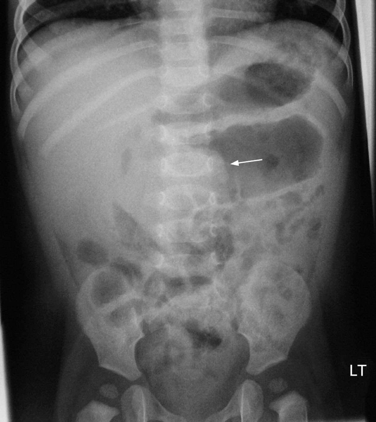 Imaging and intussusception Williams 93 (1) 30 ADC Education and Practice