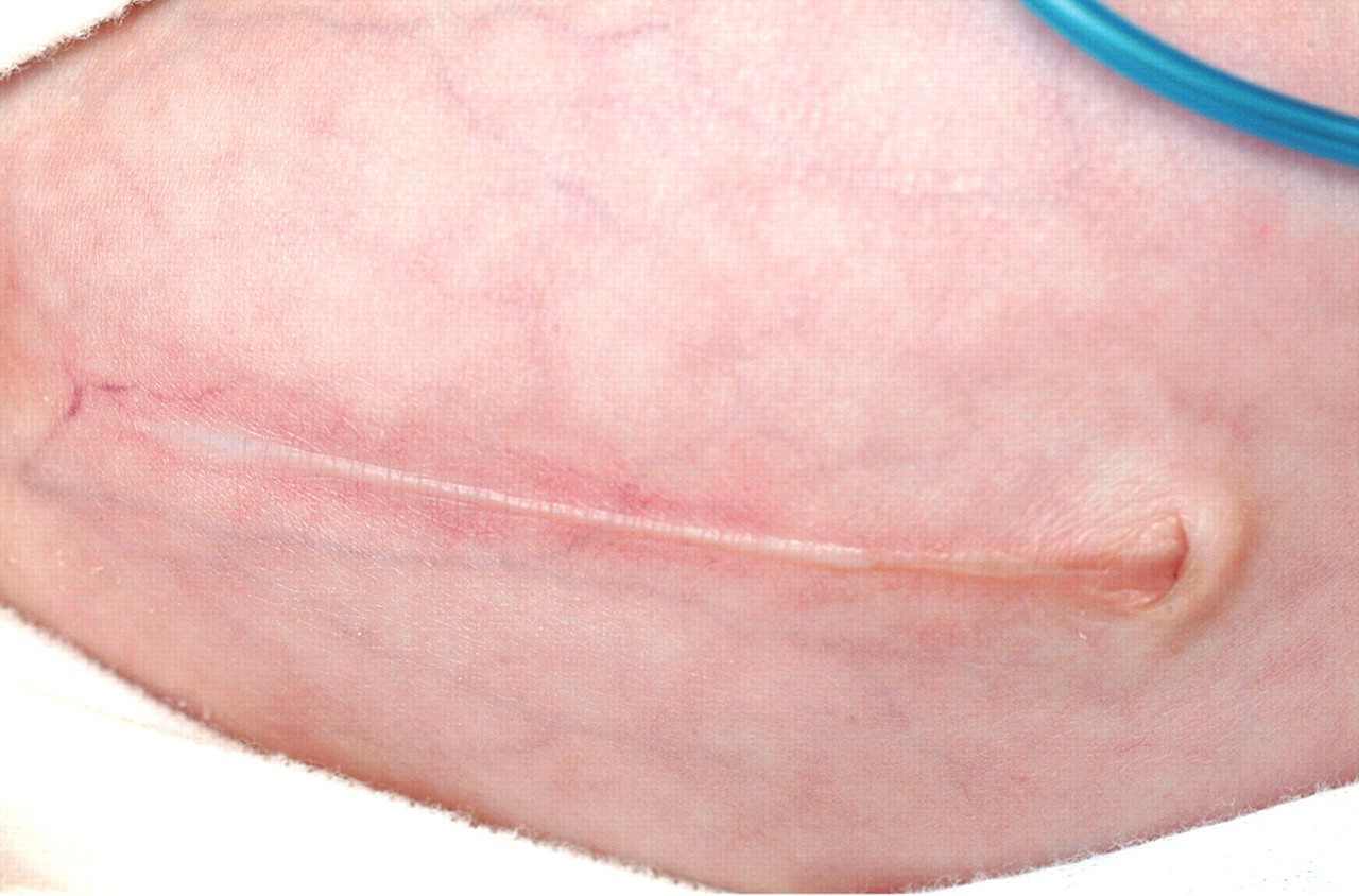 PHACES syndrome Mahadi et al. 97 (3) F209 ADC Fetal and Neonatal Edition