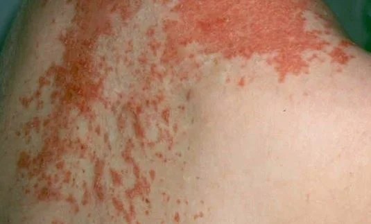 Maculopapular Rash Pictures, Causes, Treatment