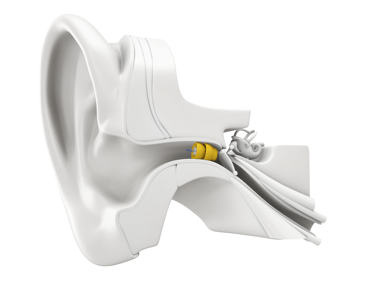Lyric Hearing Aids St. Louis Associated Hearing Professionals