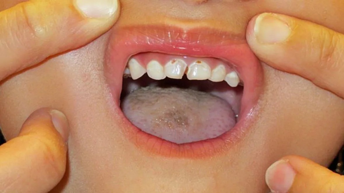 Tooth decay disease most common reason for day surgery on