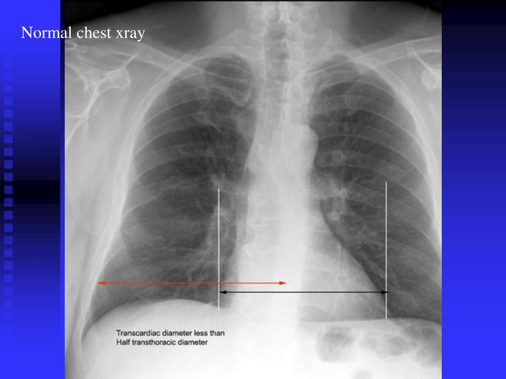 PPT Pulmonary Edema vs Pneumonia PowerPoint Presentation ID746578
