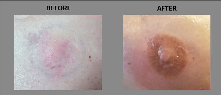 Areola Tattoo Before & After IOIO Studio