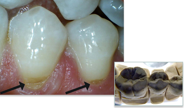 Hole In Tooth Under Gum Line A Pictures Of Hole 2018